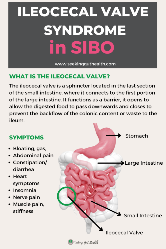 ileocecal valve syndrome in sibo